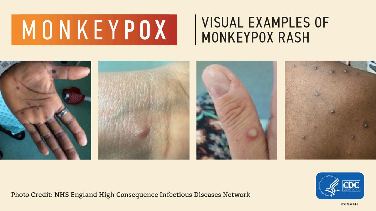 visual examples of MPX rash visual examples of MPX rash